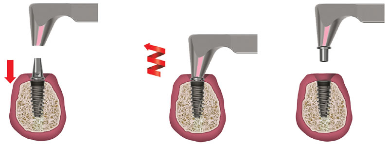 octo-implant-abutment-sabitle