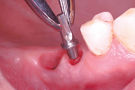 octo-implant-abutment-yerlestirilmesi