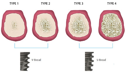 Implant system according to the bone quality