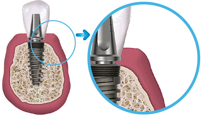 octo-implant-krestal-kemik-iliskisi