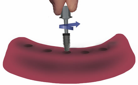 octo-implant-plastik-tasiyiciyla-yerlestirme