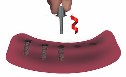 octo-implant-plastik-tutucunun-cikarilmasi