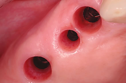 octo-implant-transgingival-goruntu-1